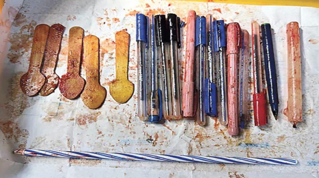 14 Pens, 5 Wooden Spoons, and Candle Removed from Woman’s Stomach in Andhra Pradesh