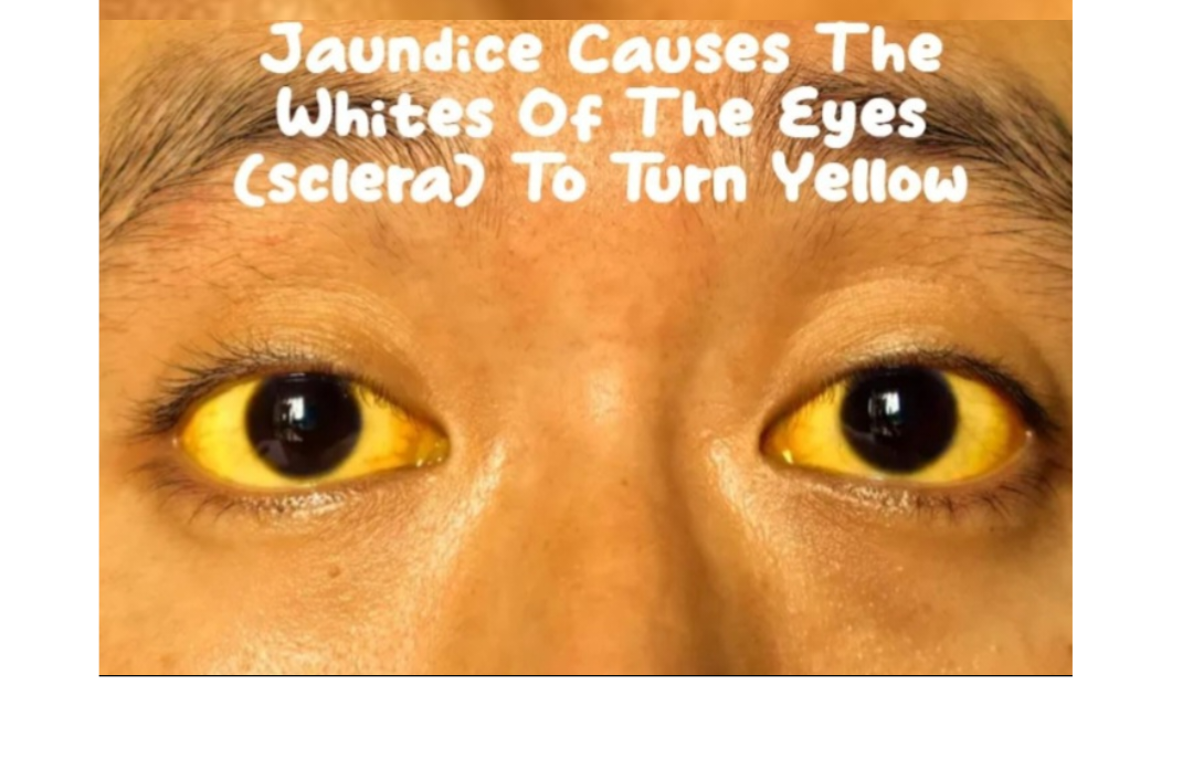 These Are The Foods That People With Jaundice Should Eat!, They Will Recover Quickly With These !