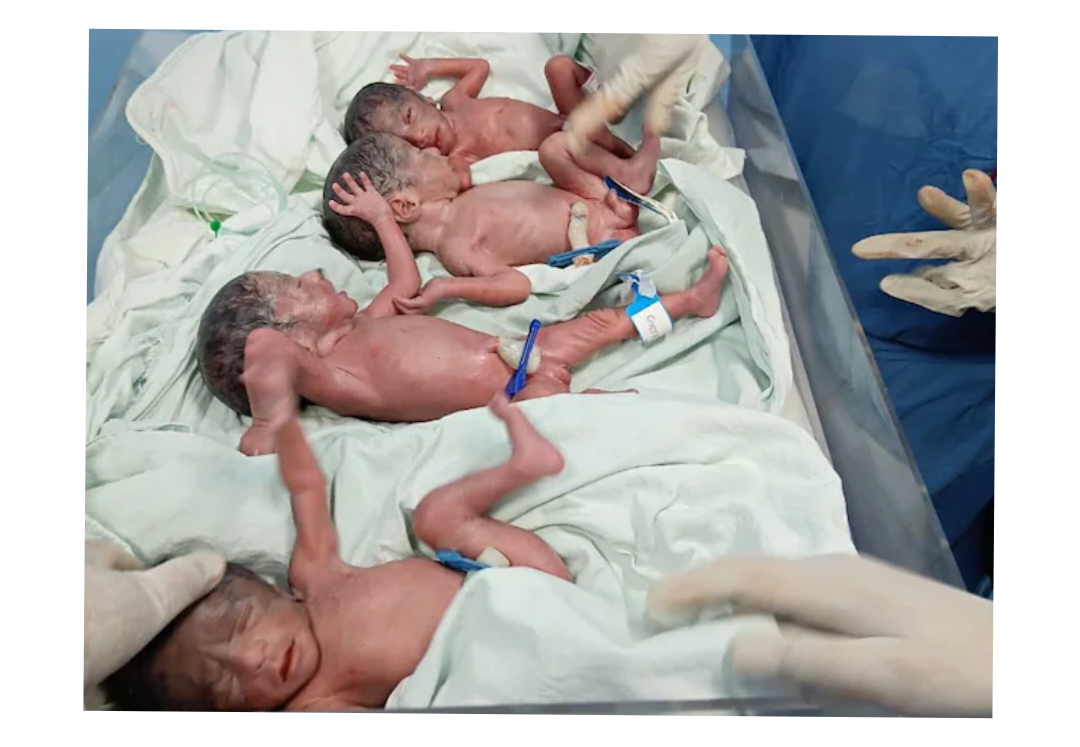 Woman Gives Birth to Quadruplets in Madhya Pradesh’s Sheopur District